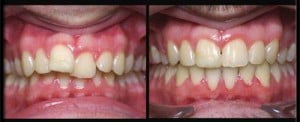 Nên niềng răng hay bọc sứ khi răng cửa bị lệch ?