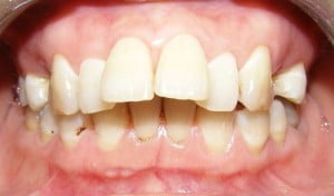 Làm gì khi bốn răng cửa bị hô