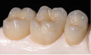 Nên chọn răng sứ nào để thẩm mỹ hàm răng