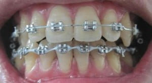 Chi phí niềng răng hô giá bao nhiêu tiền ?