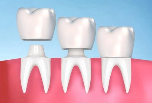 Nên chọn răng sứ nào để thẩm mỹ hàm răng 2