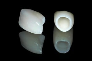 Nên trám răng hay bọc sứ khi răng bị sâu?