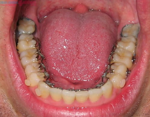 Phương pháp niềng răng thẩm mỹ