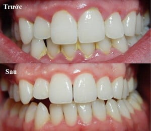 Vôi răng những điều bạn cần biết