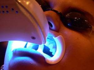 Cách làm răng trắng răng bằng công nghệ laser