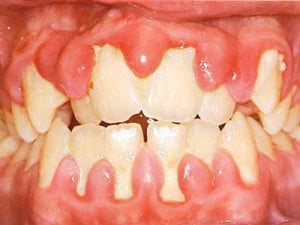 Những bệnh răng miệng thường gặp ngày nay