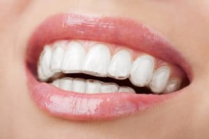 Niềng răng bằng nhựa uy tín tại TPHCM