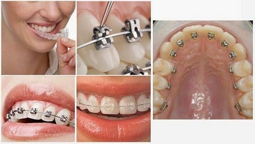 Các phương pháp niềng răng hiện nay 2