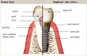 Implant nha khoa là giải pháp cấy ghép răng hiện đại 