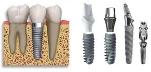 Implant nha khoa là giải pháp cấy ghép răng hiện đại 