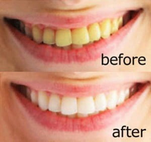Men răng sau khi tẩy trắng duy trì được lâu không?