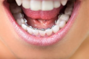 Niềng răng mặt trong hiệu quả và thẩm mỹ 