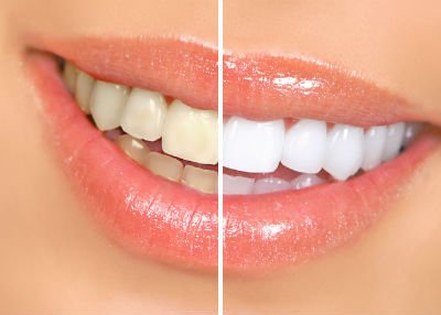 Tẩy trắng răng có lợi và có hại gì? 
