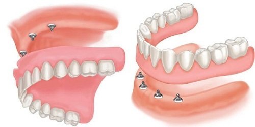 Trồng răng implant