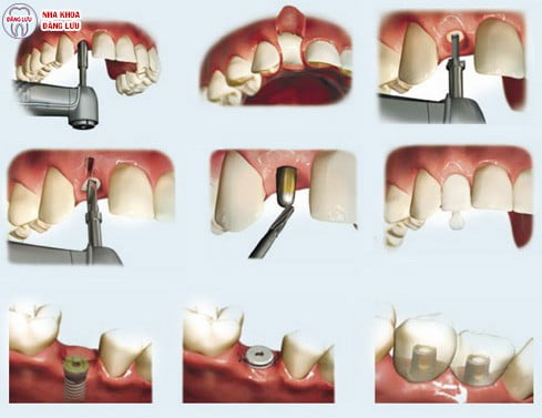 Trồng răng implant
