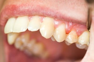 Cách khắc phục răng nanh có kích thước dài 