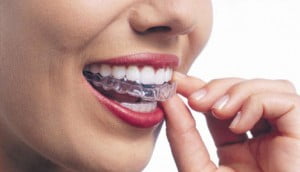 Niềng răng lệch lạc bằng khay invisalign có hiệu quả không?