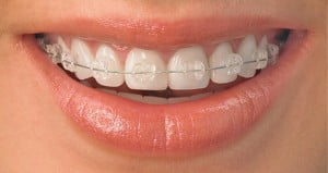 Niềng răng mắc cài mặt ngoài thẩm mỹ nhất? 