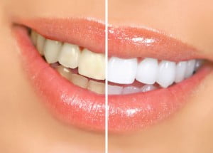 Tẩy trắng răng có bị ê buốt không? 