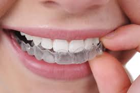 Hàm răng trắng sáng với phương pháp tẩy trắng răng