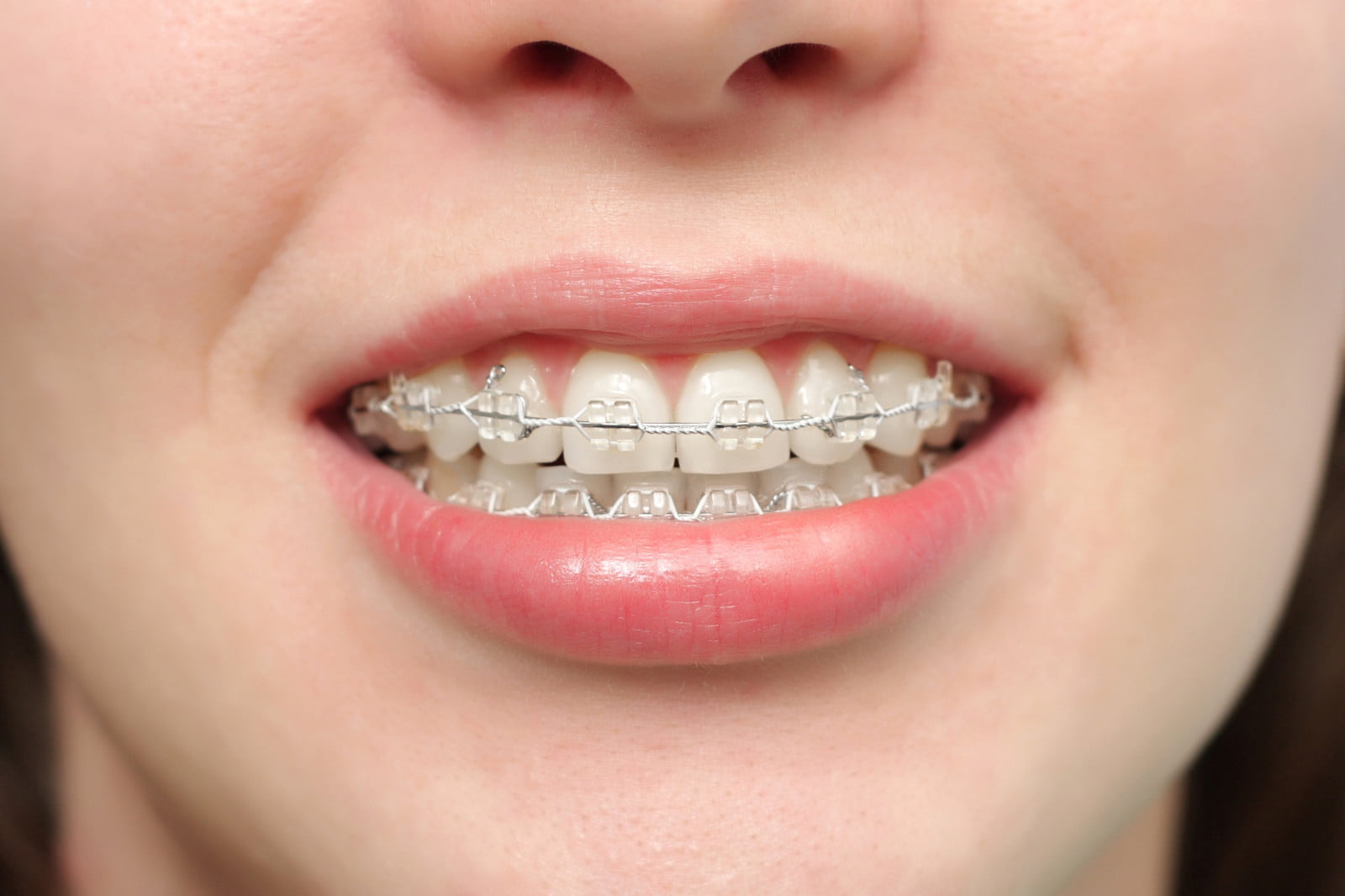 Nên chọn loại mắc cài nào khi niềng răng?