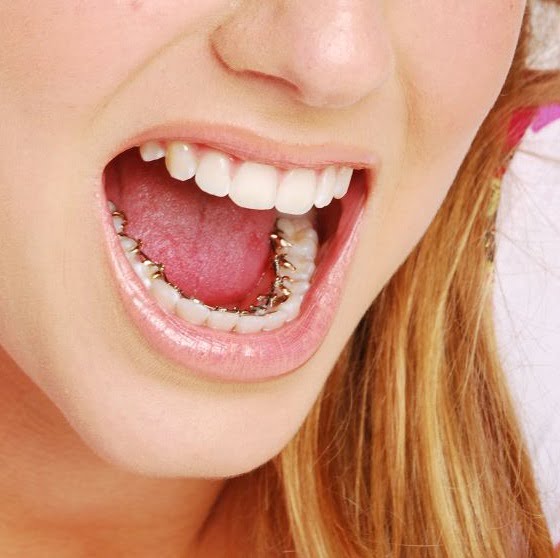 Nên chọn loại mắc cài nào khi niềng răng?