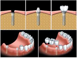 Trồng răng hoàn hảo với implant nha khoa
