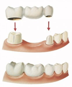 Bí quyết cải thiện tình trạng bị mất răng 
