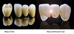 Loại răng sứ nào được bảo hành lâu nhất? 
