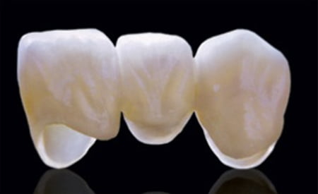 Loại răng sứ nào được bảo hành lâu nhất?