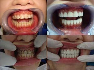 Quá trình bọc răng sứ như thế nào? 