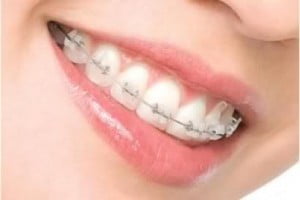 Trồng răng sứ có niềng răng được không?