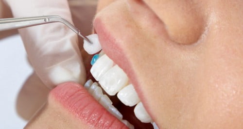 Bọc răng sứ có hại gì không