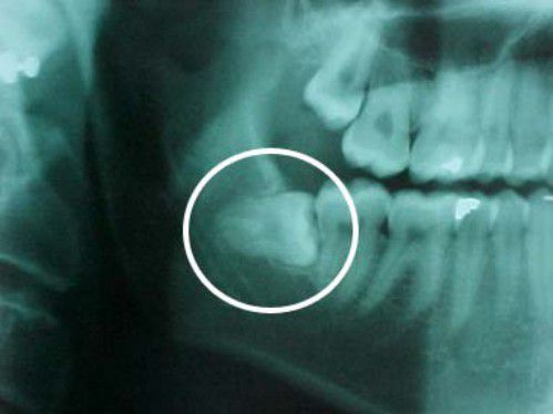 Nhổ răng khôn khi niềng răng Invisalign