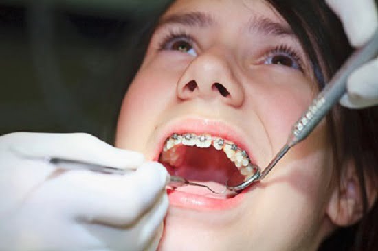 Đặc trưng của quy trình niềng răng mắc cài