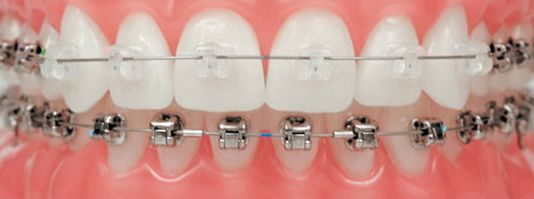 Hàm có răng cấy ghép implant có niềng răng được không?