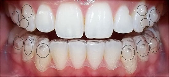 Tại sao niềng răng Invisalign sử dụng nhiều khay niềng?