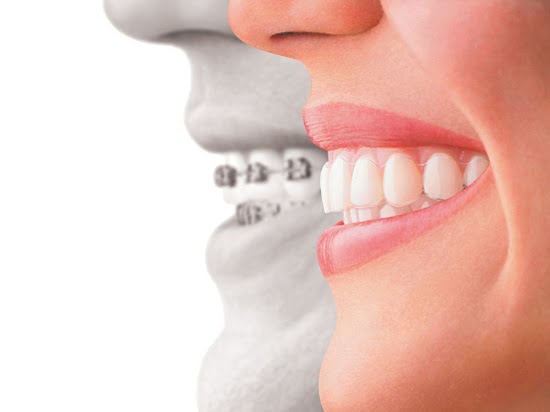 Chỉnh hình răng và những điều cần biết