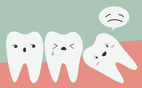 Nhổ răng khi niềng răng Invisalign 
