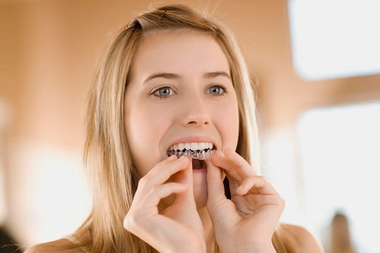 Hạn chế của niềng răng không mắc cài Invisalign