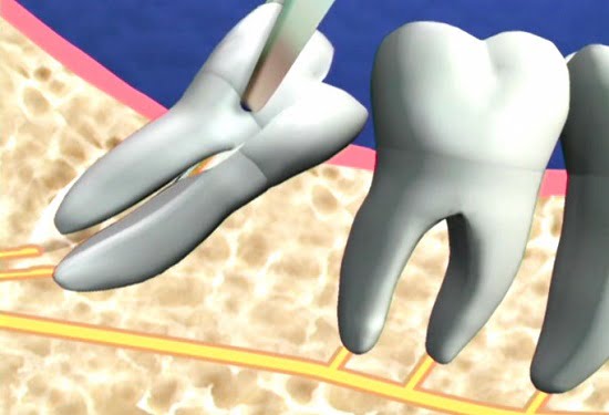 Niềng răng điều trị răng nanh mọc ngầm trong xương hàm 