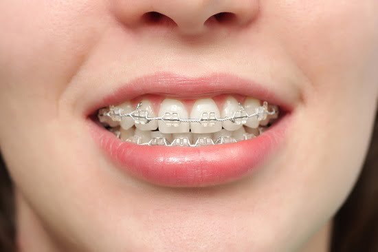 Răng hơi hô có nên niềng răng không?