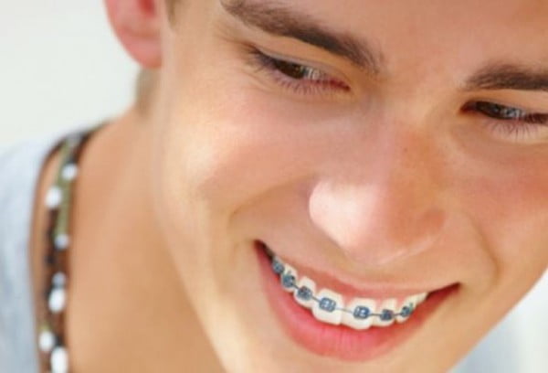 Khi niềng răng, răng cần phải được chăm sóc kỹ gấp 2 lần