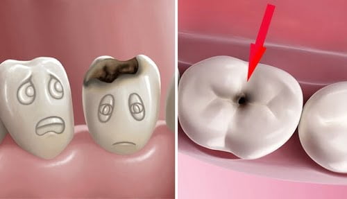 Đang bị sâu răng có niềng răng được không? 1
