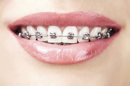 Đang bị sâu răng có niềng răng được không?