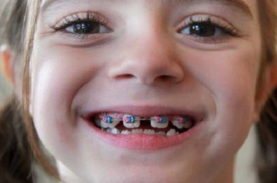 Loại mắc cài nào phù hợp để niềng răng trẻ em?