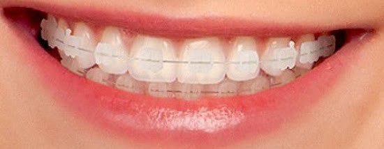Điều trị hô bằng niềng răng mắc cài sứ 