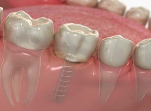 Cấy ghép implant vào thời điểm nào là hợp lý nhất?