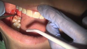 Những tai biến có thể xảy ra trong cấy ghép implant