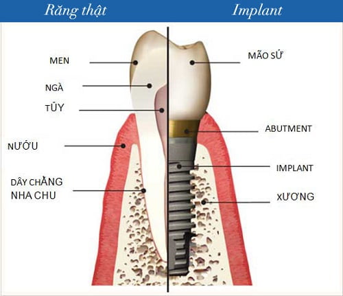 Răng implant có nhai tốt không?
